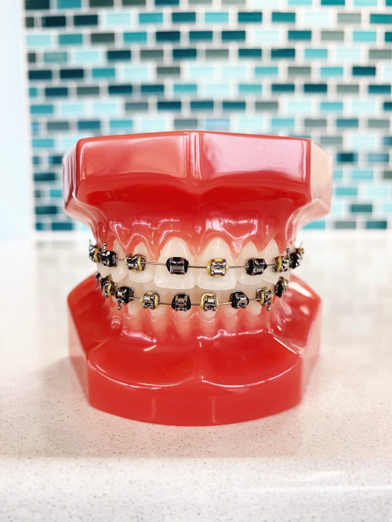 Top Braces Color Combinations With Major Winter Vibes