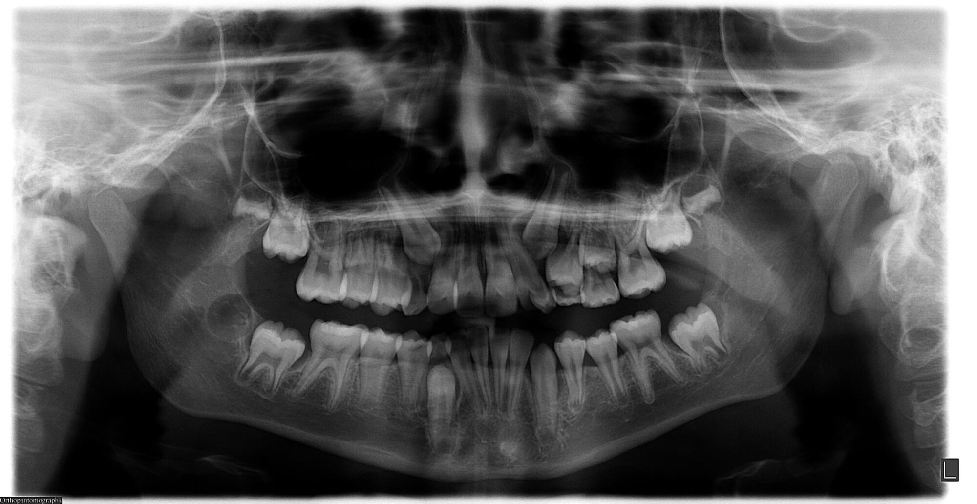 Impacted Canines