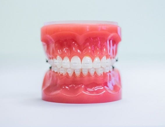 clear-braces-ceramic-brackets-model-omaha Model showing clear braces with ceramic brackets for a more discreet look
