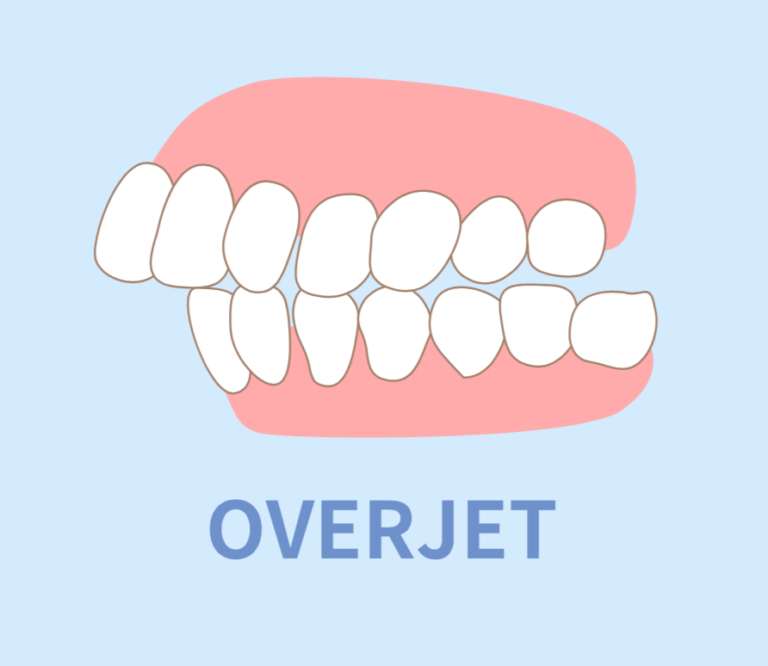 Underbite Vs Overbite Whats The Difference And How Are They Treated