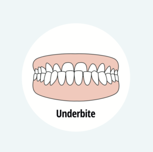 Underbite vs. Overbite: What’s the Difference and How are They Treated ...