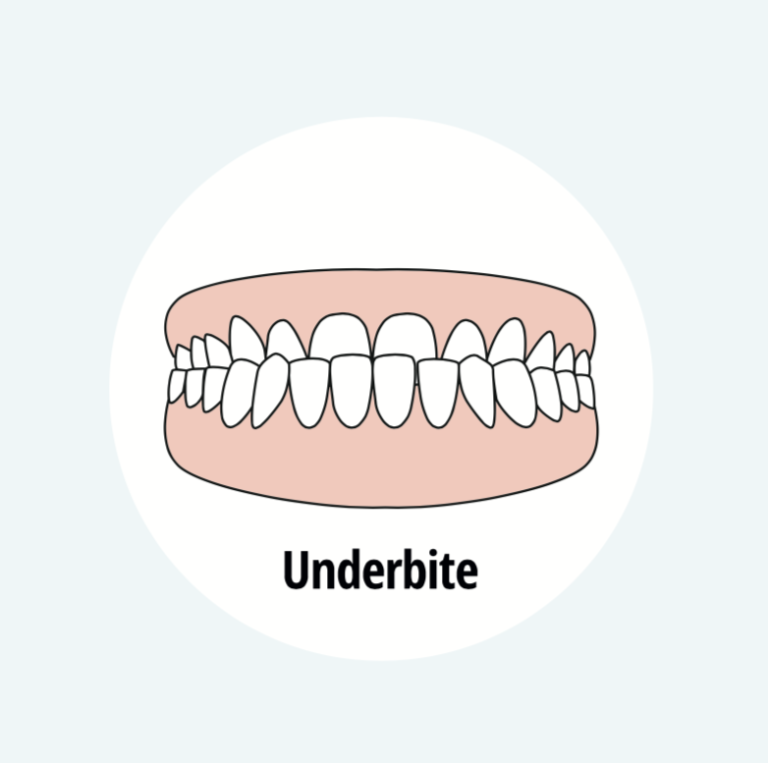 Underbite Vs Overbite Whats The Difference And How Are They Treated