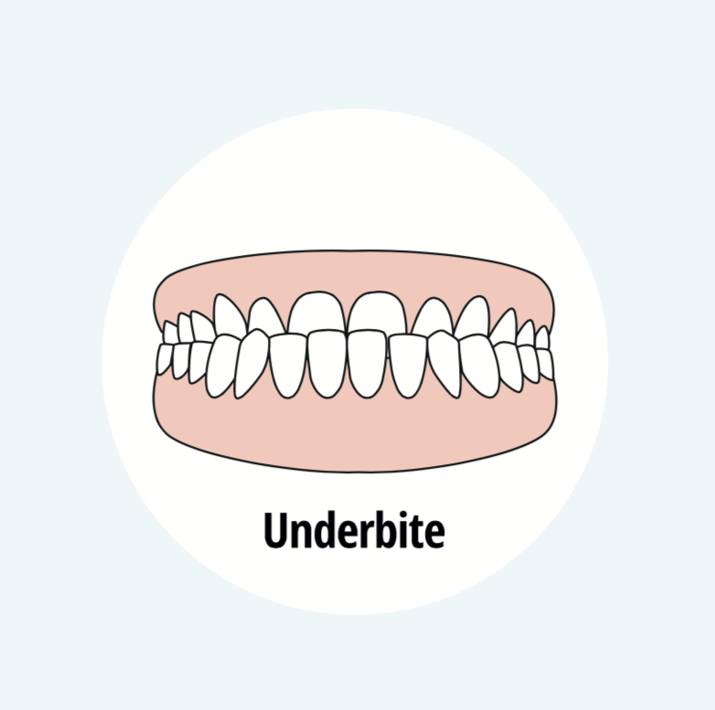 What to Know About Overbite and Underbite - Johnson & Collins