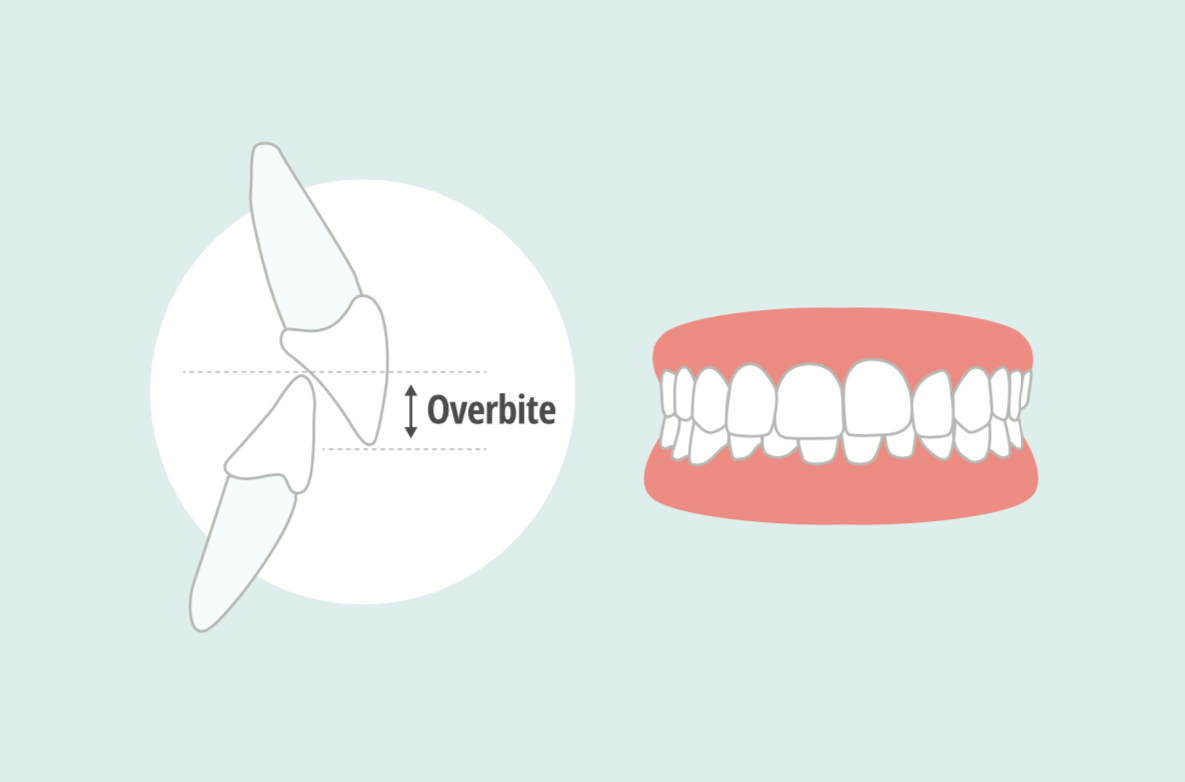 Underbite vs. Overbite: What's the Difference and How are They Treated?