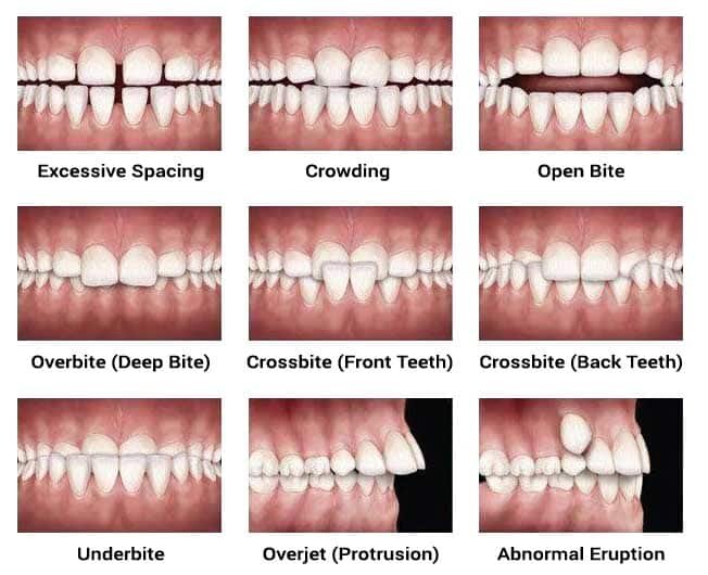 Underbite vs. Overbite: What's the Difference and How are They