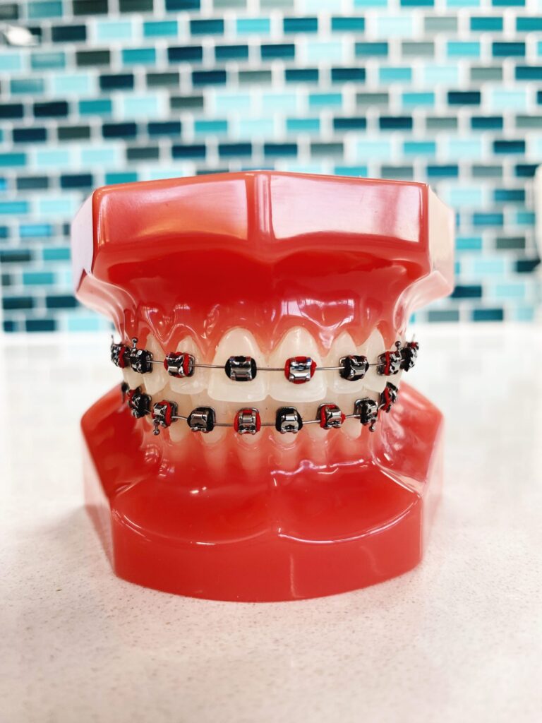 Braces Rubber Band Colors: Red and black