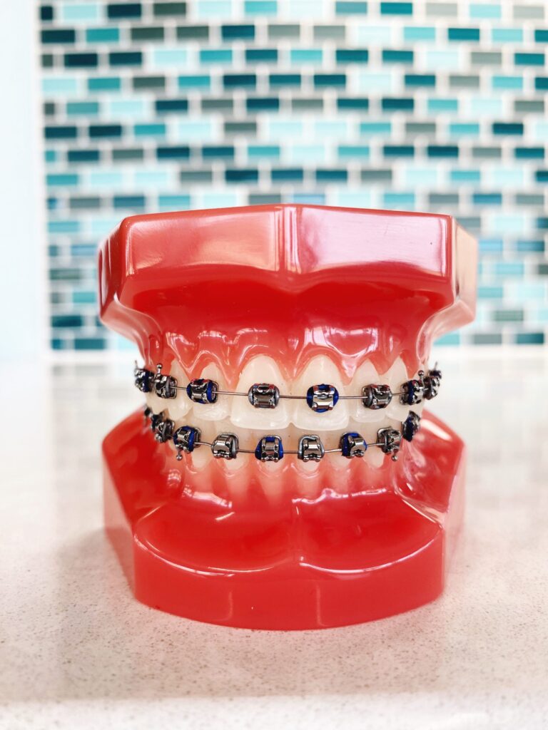 Braces Rubber Band Colors: Navy blue and silver