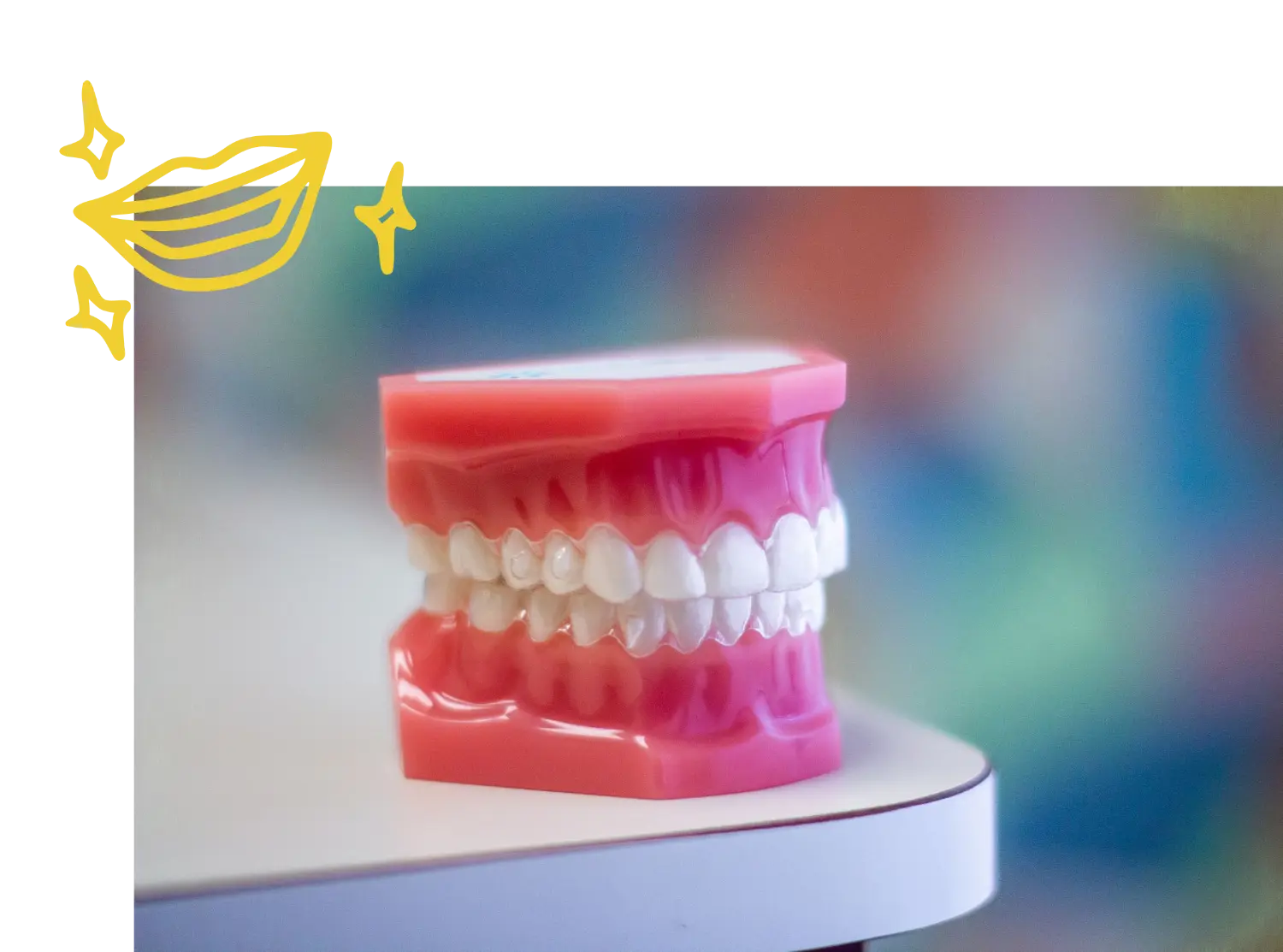 Clear aligner on a dental model for Invisalign treatment in Omaha